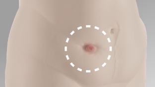 Abdomen shown of someone that has a body profile with an inward area around the stoma